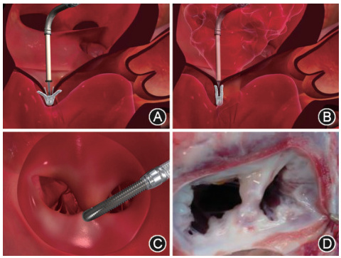 經(jīng)導管二尖瓣夾系統(tǒng)醫(yī)療器械注冊證辦理指南(圖2)