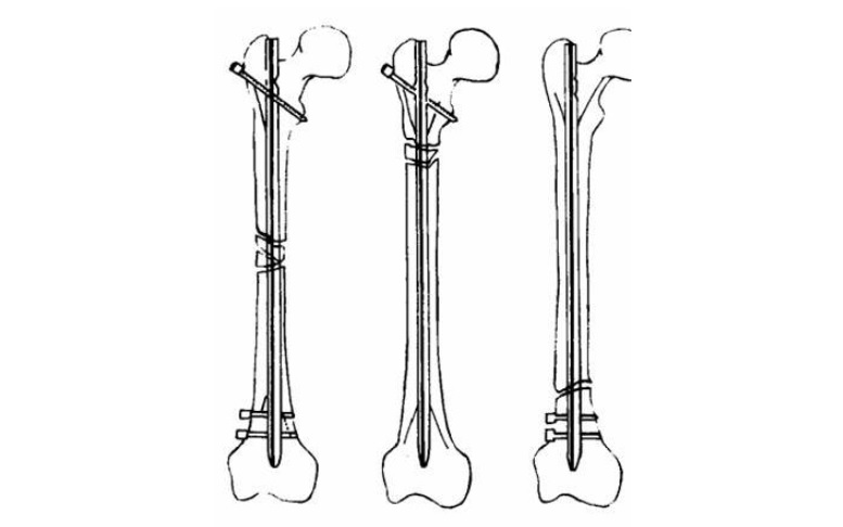 骨科金屬植入物產(chǎn)品注冊申報資料關注點
