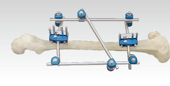 骨科外固定支架注冊技術(shù)審查指導(dǎo)原則（2018年修訂）（2018年第107號）(圖1)
